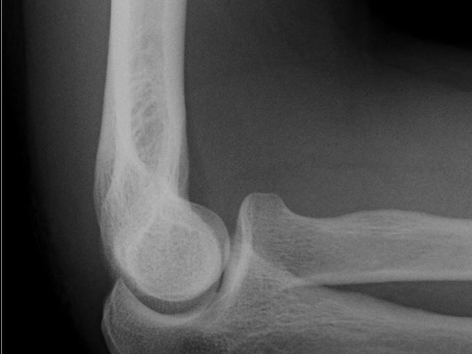 elbow-normal-anterior-fat-pad